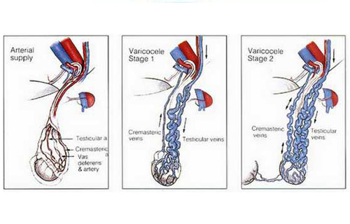 精索静脉曲张