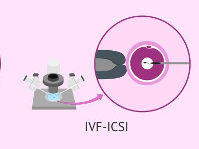 卵胞浆内单精子显微注射技术