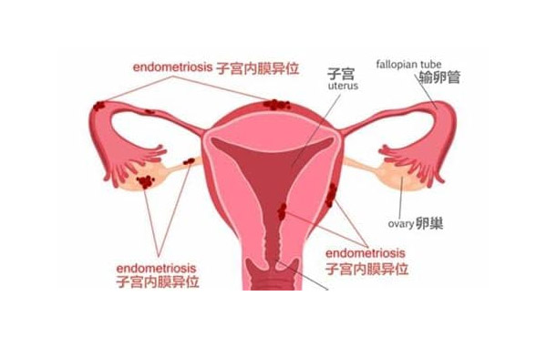 内膜异位症