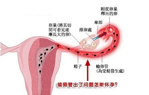 输卵管疾病